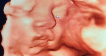 Ginekološka ordinacija Novi Sad - 3D-4D ultrazvučni pregled - Biovita